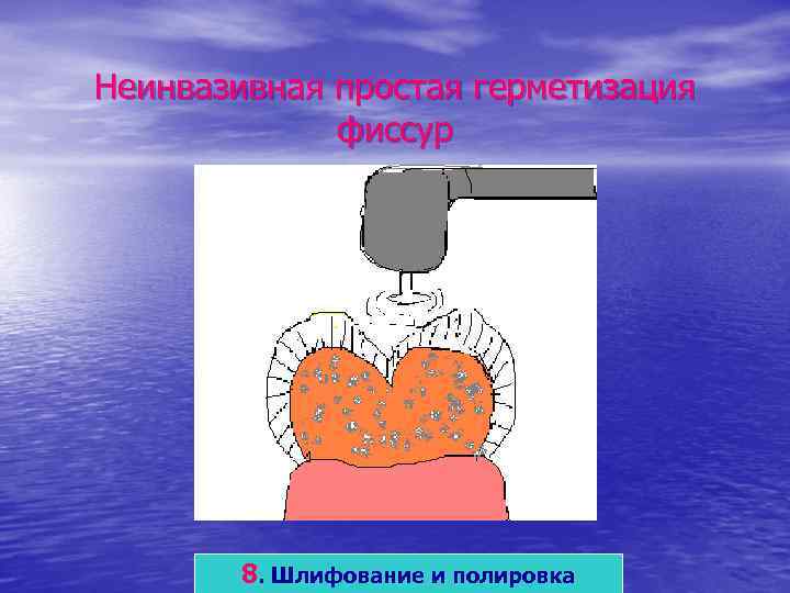 Неинвазивная простая герметизация   фиссур   8. Шлифование и полировка 