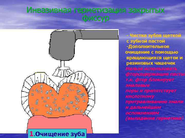 Инвазивная герметизация закрытых   фиссур    - Чистка зубов щеткой 