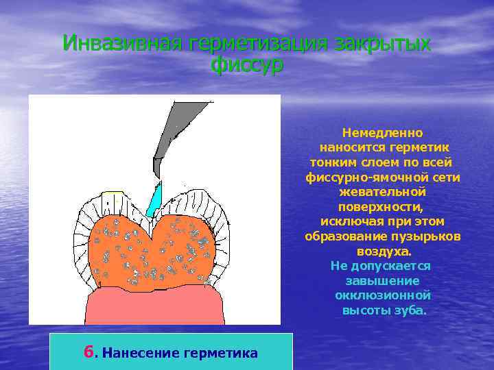 Инвазивная герметизация закрытых   фиссур      Немедленно  