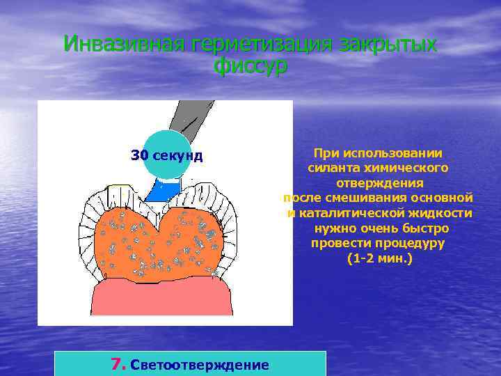 Инвазивная герметизация закрытых   фиссур   30 секунд    При