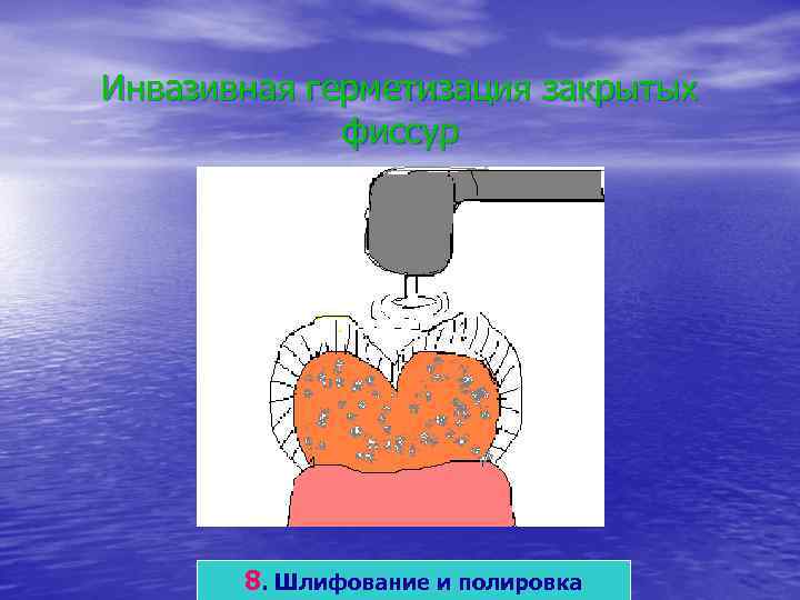 Инвазивная герметизация закрытых   фиссур  8. Шлифование и полировка 