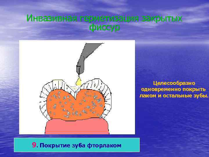 Инвазивная герметизация закрытых   фиссур    Целесообразно    