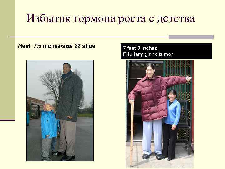   Избыток гормона роста с детства 7 feet 7. 5 inches/size 26 shoe