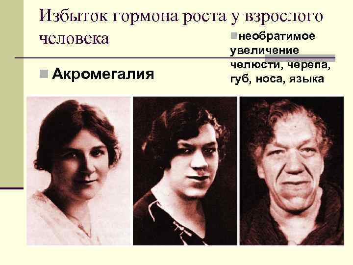 Избыток гормона роста у взрослого человека   nнеобратимое    увеличение 