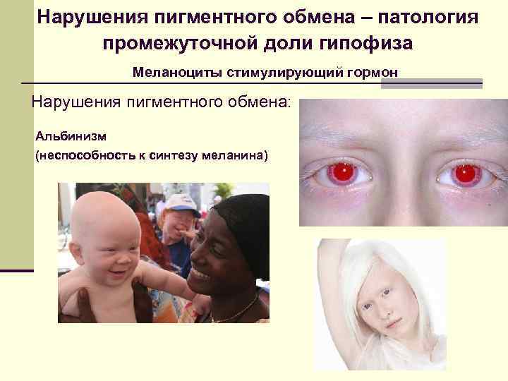 Нарушения пигментного обмена – патология промежуточной доли гипофиза    Mеланоциты стимулирующий гормон