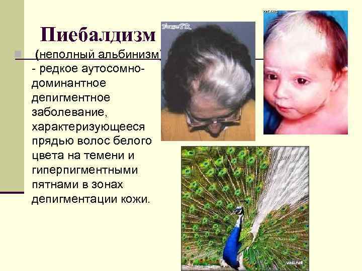  Пиебалдизм n  (неполный альбинизм) - редкое аутосомно- доминантное депигментное заболевание, характеризующееся прядью