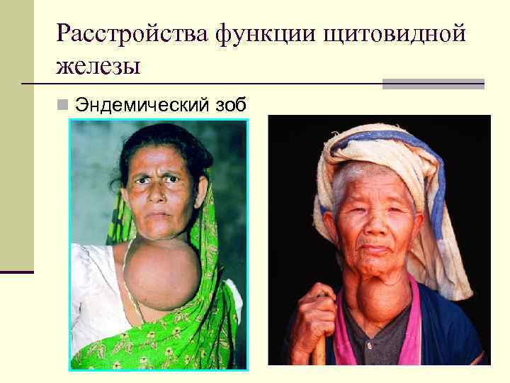Расстройства функции щитовидной железы n Эндемический зоб 