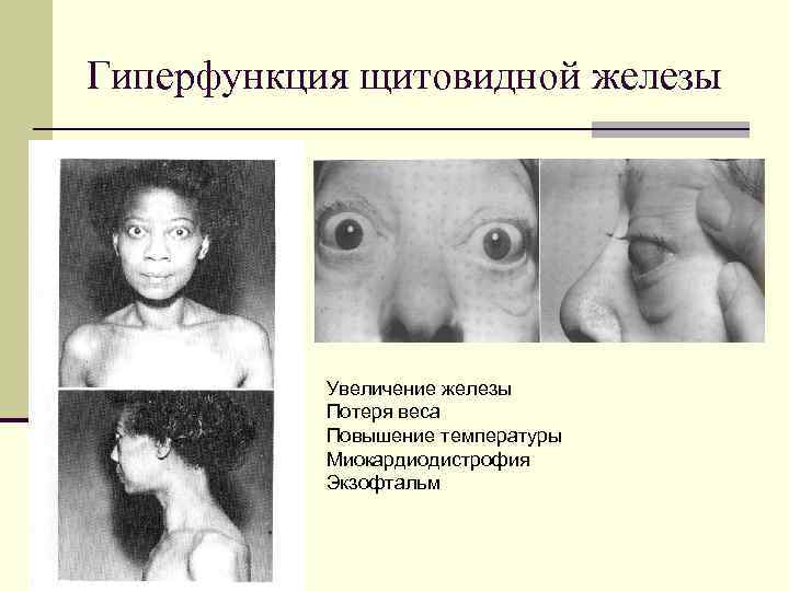 Гиперфункция щитовидной железы    Увеличение железы  Потеря веса  Повышение температуры