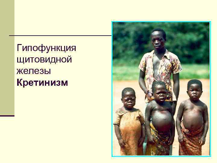 Гипофункция щитовидной железы Кретинизм 