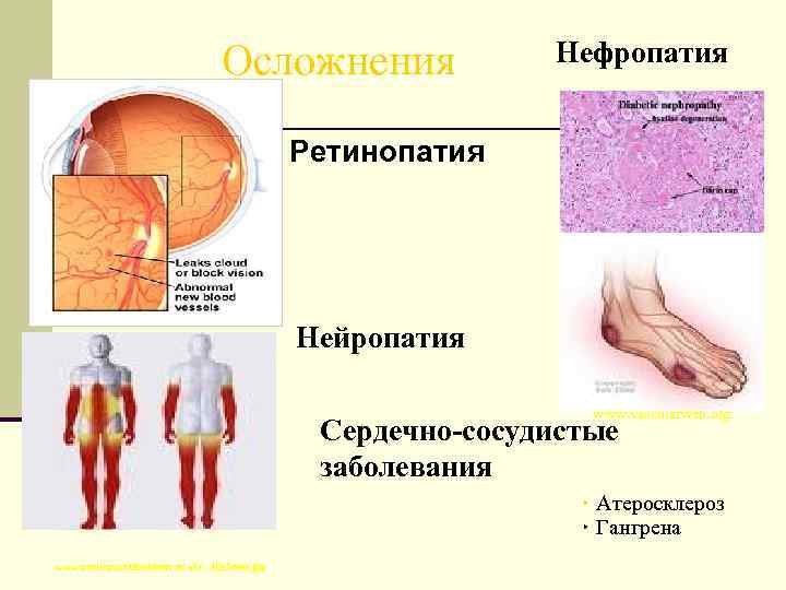        Осложнения    Нефропатия  