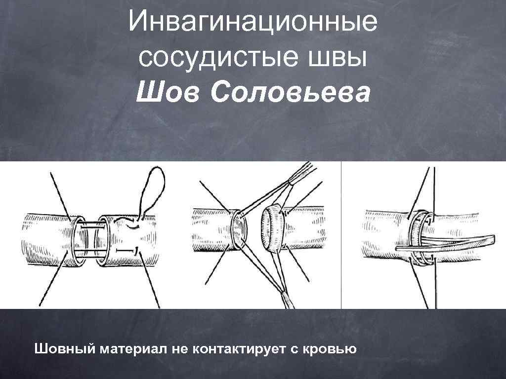 Инвагинационные сосудистые швы Шов Cоловьева Шовный материал не контактирует с кровью 