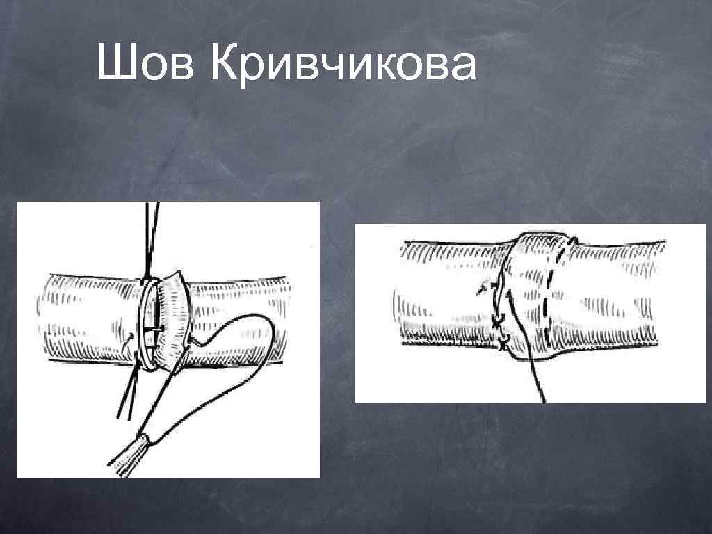 Шов Кривчикова 