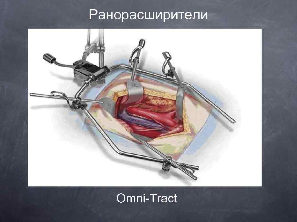 Ранорасширители Omni-Tract 