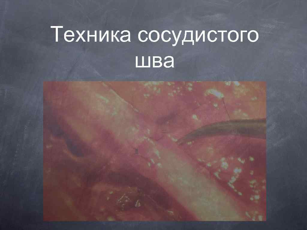 Техника сосудистого шва 