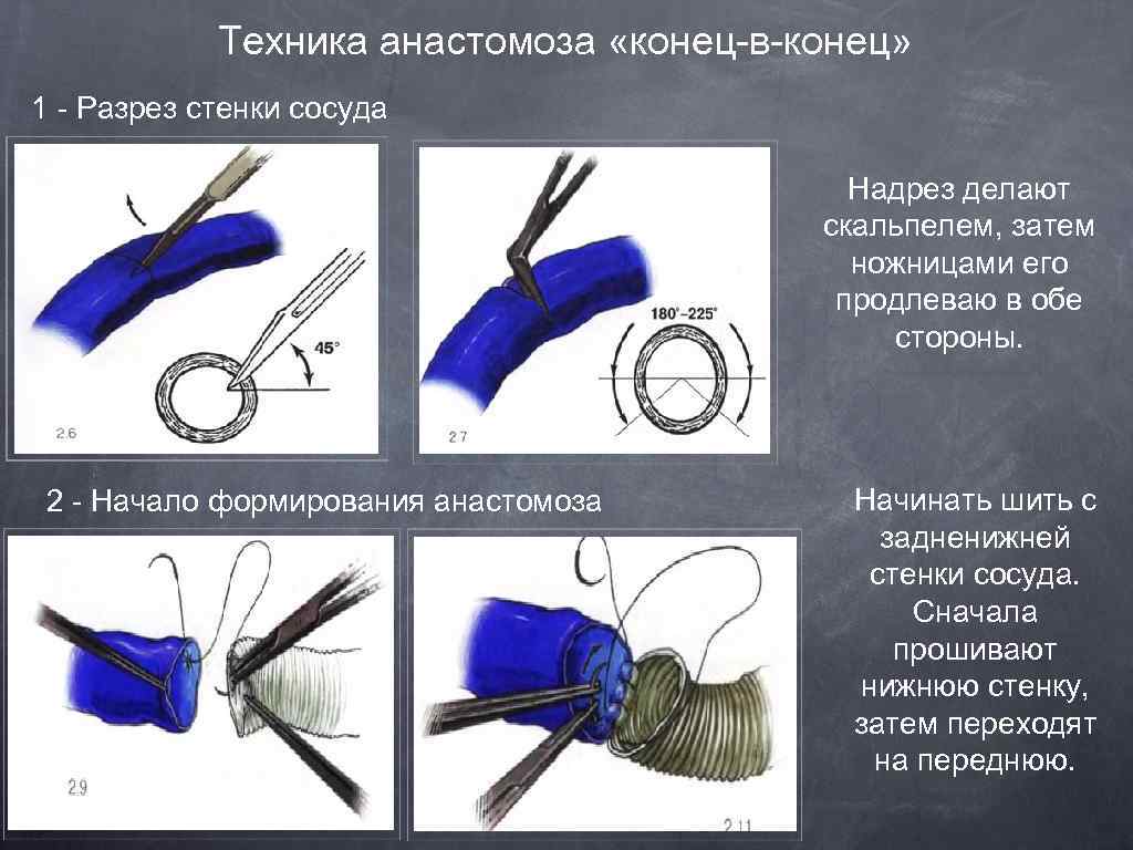 Техника анастомоза «конец-в-конец» 1 - Разрез стенки сосуда Надрез делают скальпелем, затем ножницами его