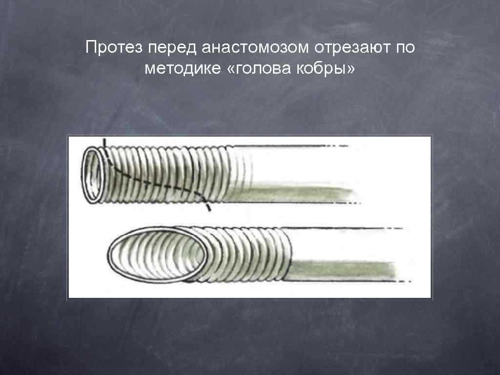 Протез перед анастомозом отрезают по методике «голова кобры» 