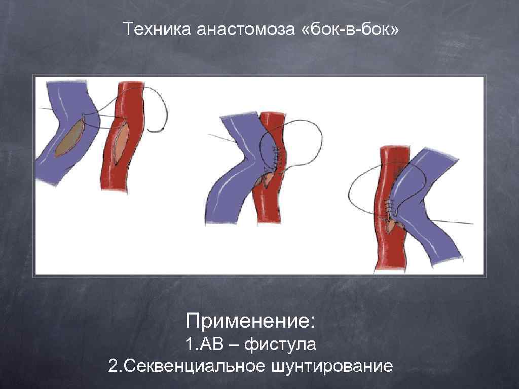 Техника анастомоза «бок-в-бок» Применение: 1. АВ – фистула 2. Секвенциальное шунтирование 