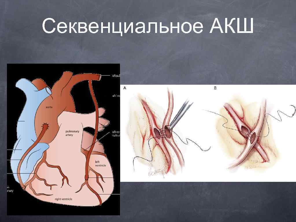 Секвенциальное АКШ 