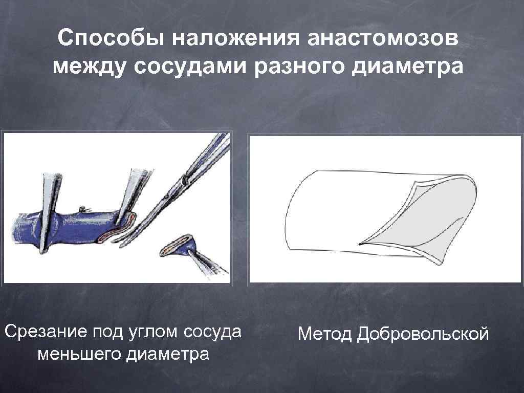 Метод наложения. Способы наложения анастомозов. Наложение сосудистого анастомоза. Шов сосудов разного диаметра.