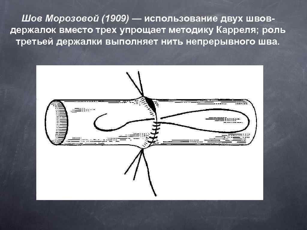 Шов Морозовой (1909) — использование двух швовдержалок вместо трех упрощает методику Карреля; роль третьей