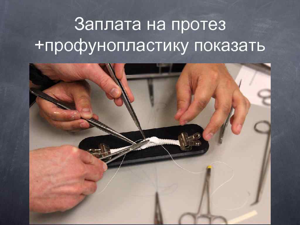 Заплата на протез +профунопластику показать 