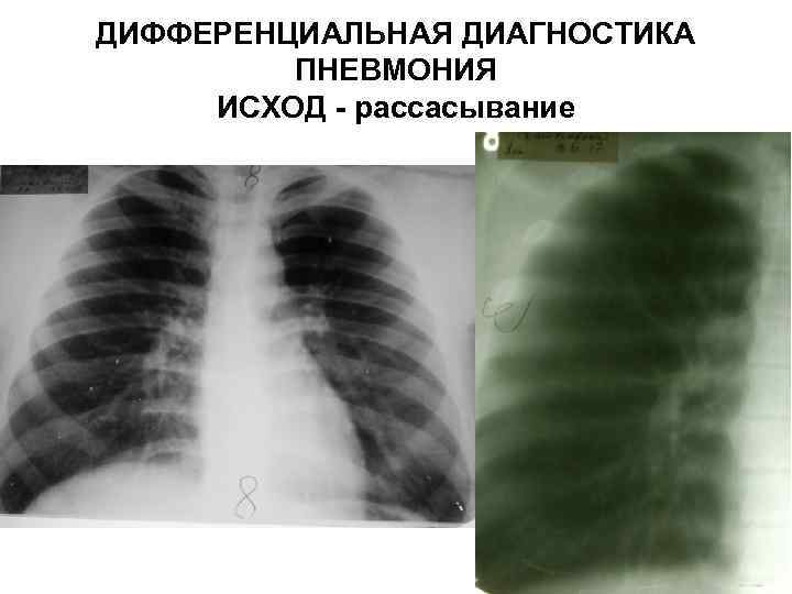 ДИФФЕРЕНЦИАЛЬНАЯ ДИАГНОСТИКА ПНЕВМОНИЯ ИСХОД - рассасывание 
