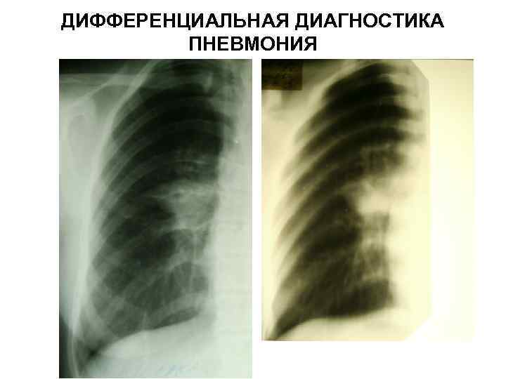 ДИФФЕРЕНЦИАЛЬНАЯ ДИАГНОСТИКА ПНЕВМОНИЯ 