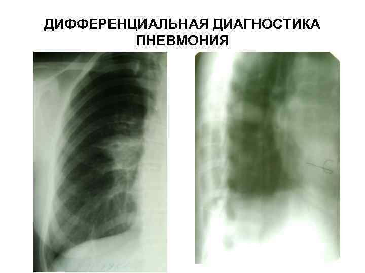 ДИФФЕРЕНЦИАЛЬНАЯ ДИАГНОСТИКА ПНЕВМОНИЯ 