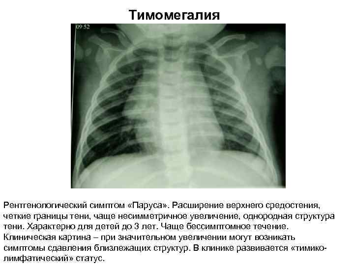 Синдром патологии легочного рисунка