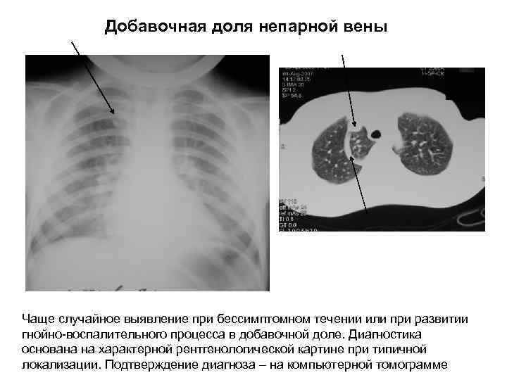 Добавочная доля непарной вены Чаще случайное выявление при бессимптомном течении или при развитии гнойно-воспалительного
