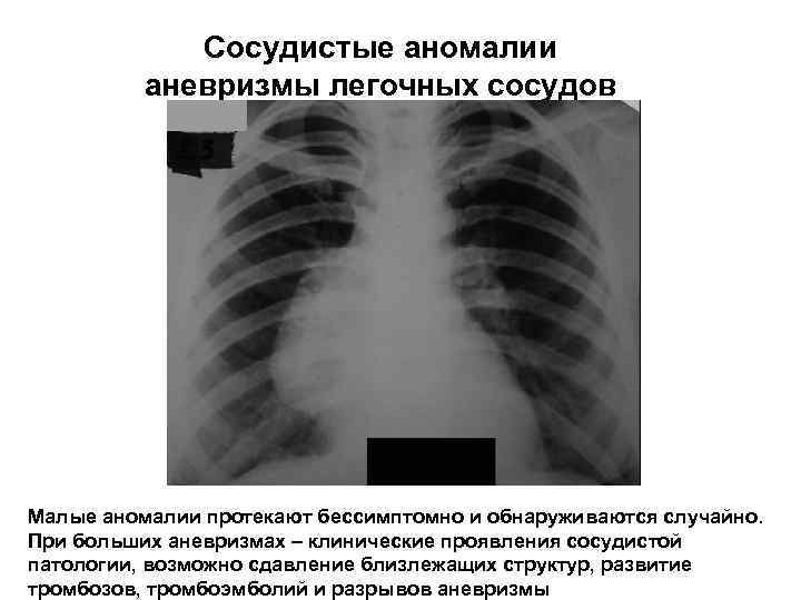 Сосудистые аномалии аневризмы легочных сосудов Малые аномалии протекают бессимптомно и обнаруживаются случайно. При больших