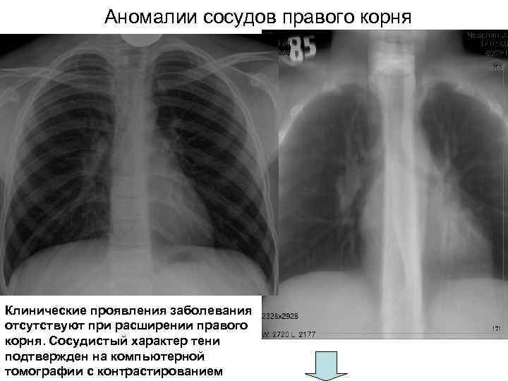 Аномалии сосудов правого корня Клинические проявления заболевания отсутствуют при расширении правого корня. Сосудистый характер