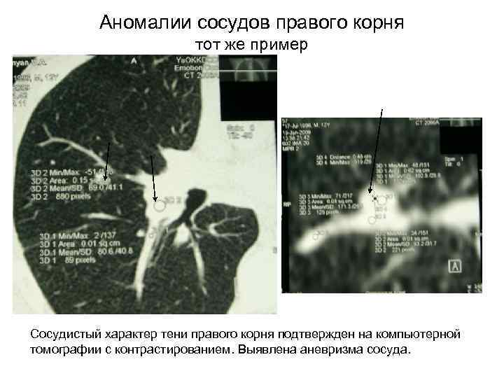 Аномалии сосудов правого корня тот же пример Сосудистый характер тени правого корня подтвержден на