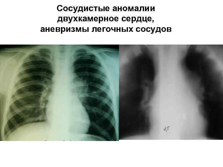 Сосудистые аномалии двухкамерное сердце, аневризмы легочных сосудов 
