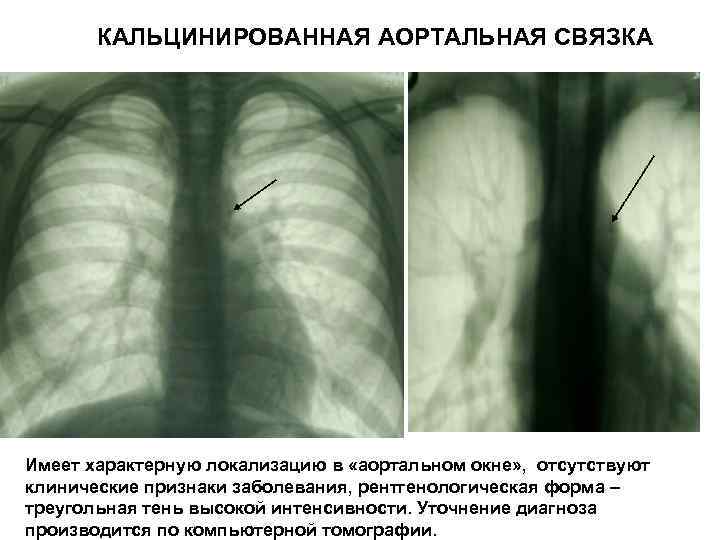 Кальцинаты в стенках аорты