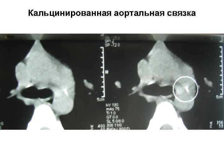 Кальцинированная аортальная связка 