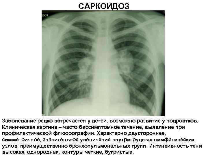 Лимфоузлы в легких причины. Саркоидоз рентген грудной клетки. Патология корня легкого рентген. Рентген лимфоузлов средостения.