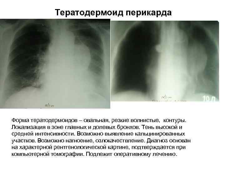 Тератодермоид перикарда Форма тератодермоидов – овальная, резкие волнистые, контуры. Локализация в зоне главных и