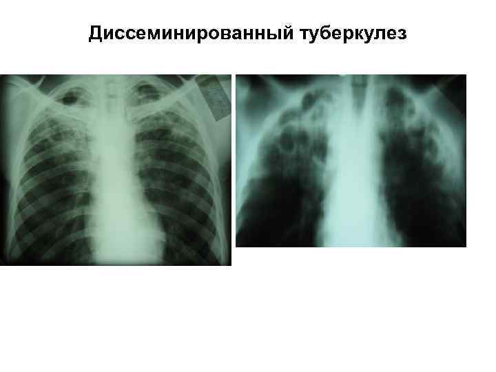 Диссеминированный туберкулез 