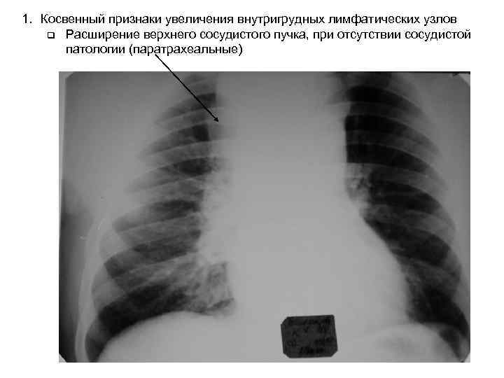 1. Косвенный признаки увеличения внутригрудных лимфатических узлов q Расширение верхнего сосудистого пучка, при отсутствии