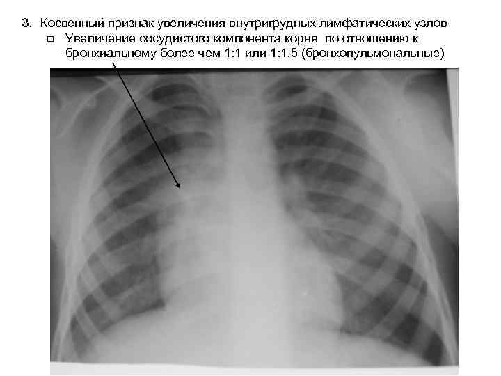 3. Косвенный признак увеличения внутригрудных лимфатических узлов q Увеличение сосудистого компонента корня по отношению
