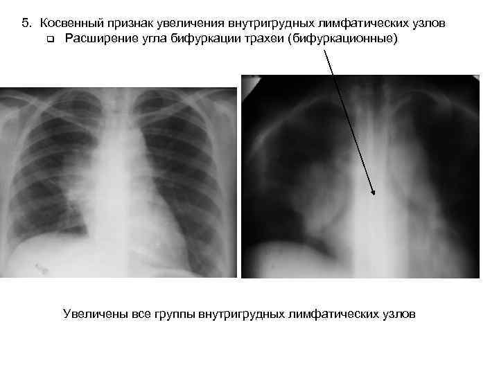 5. Косвенный признак увеличения внутригрудных лимфатических узлов q Расширение угла бифуркации трахеи (бифуркационные) 