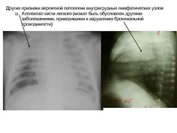 Другие признаки вероятной патологии внутригрудных лимфатических узлов q Ателектаз части легкого (может быть обусловлен