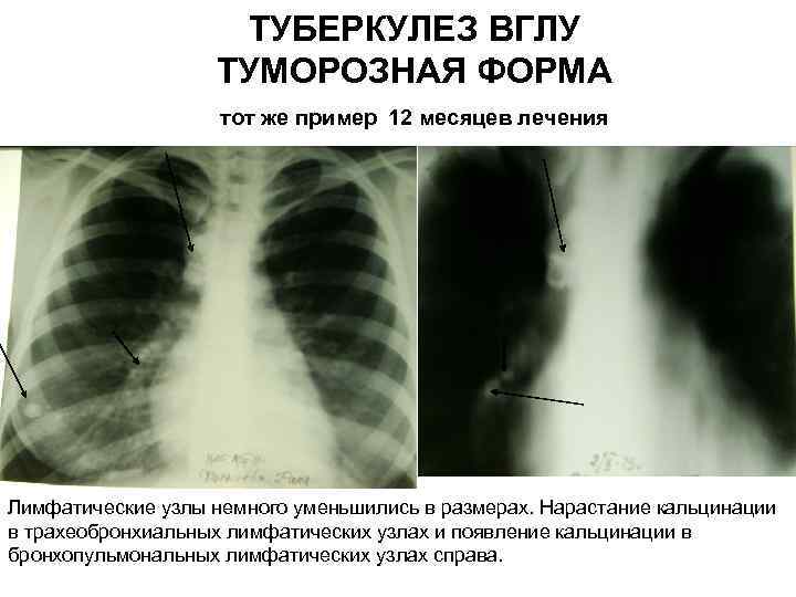     ТУБЕРКУЛЕЗ ВГЛУ    ТУМОРОЗНАЯ ФОРМА   