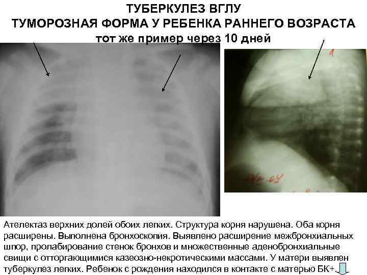     ТУБЕРКУЛЕЗ ВГЛУ ТУМОРОЗНАЯ ФОРМА У РЕБЕНКА РАННЕГО ВОЗРАСТА  тот