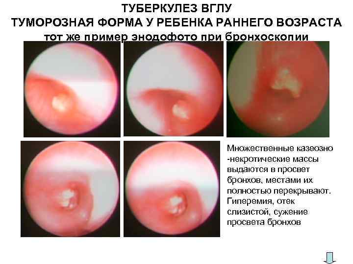     ТУБЕРКУЛЕЗ ВГЛУ ТУМОРОЗНАЯ ФОРМА У РЕБЕНКА РАННЕГО ВОЗРАСТА тот же