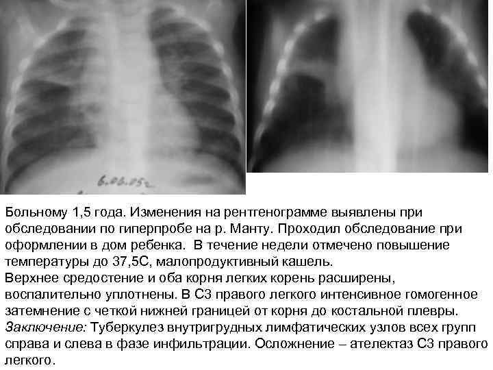 Больному 1, 5 года. Изменения на рентгенограмме выявлены при обследовании по гиперпробе на р.