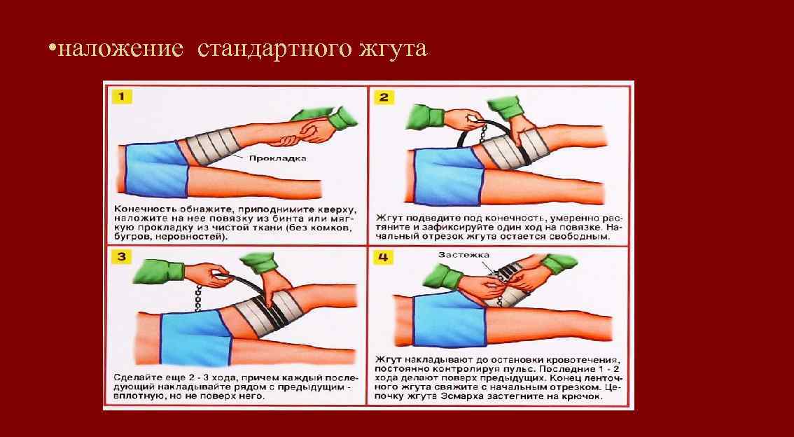  • наложение стандартного жгута 
