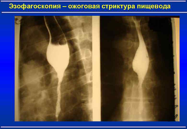 Эзофагоскопия – ожоговая стриктура пищевода 29 