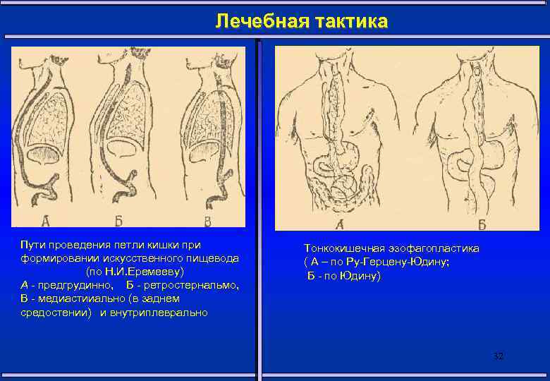 Заболевания пищевода факультетская хирургия презентация